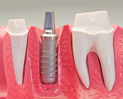 Clínica Dental Portus implante dental